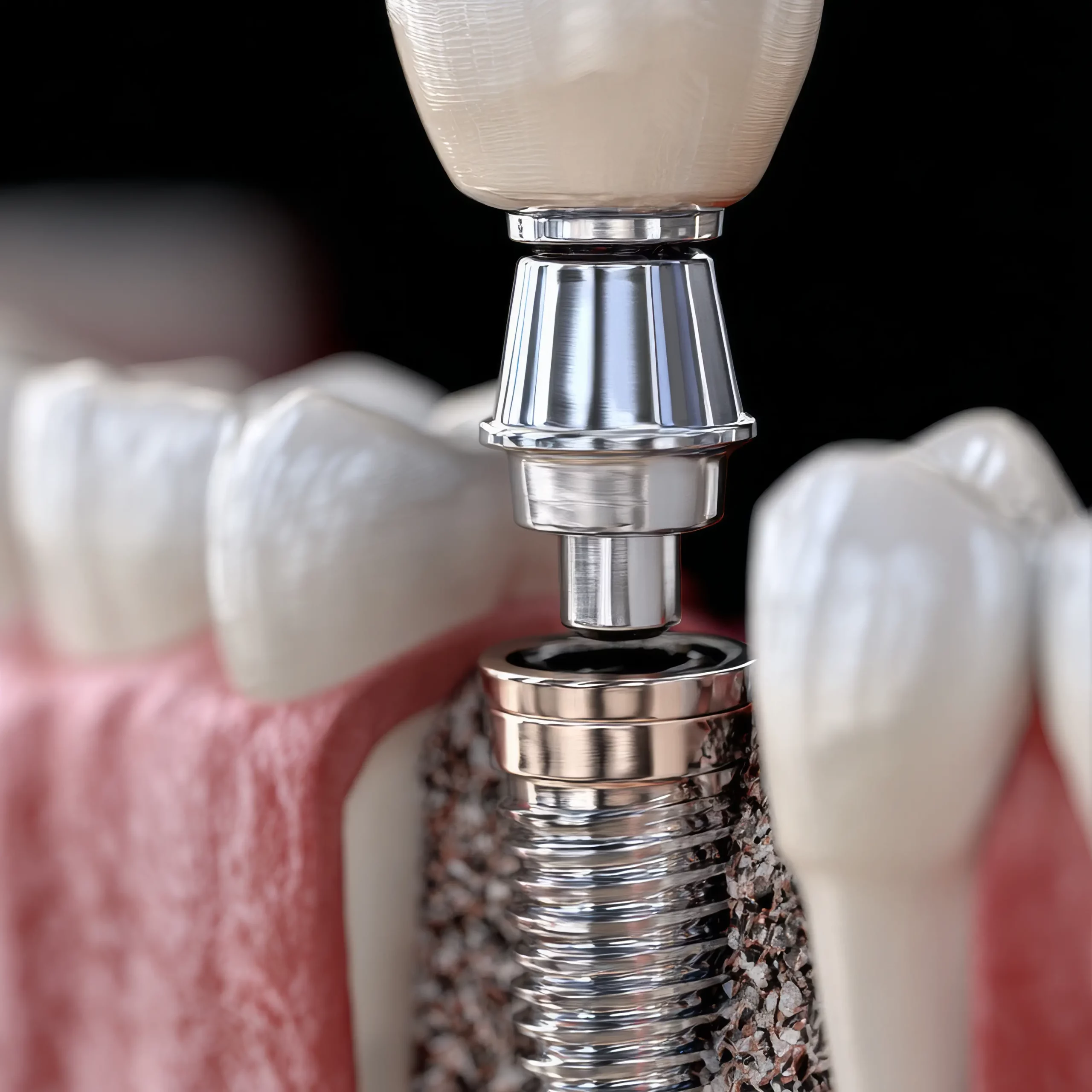 청라 임플란트 치과